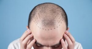 Interesting Facts You Need To Know About Hair Transplantation
