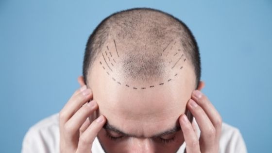 Interesting Facts You Need To Know About Hair Transplantation