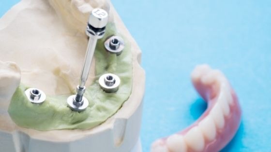 A Brief Guide to Multi-Unit Implant Abutment